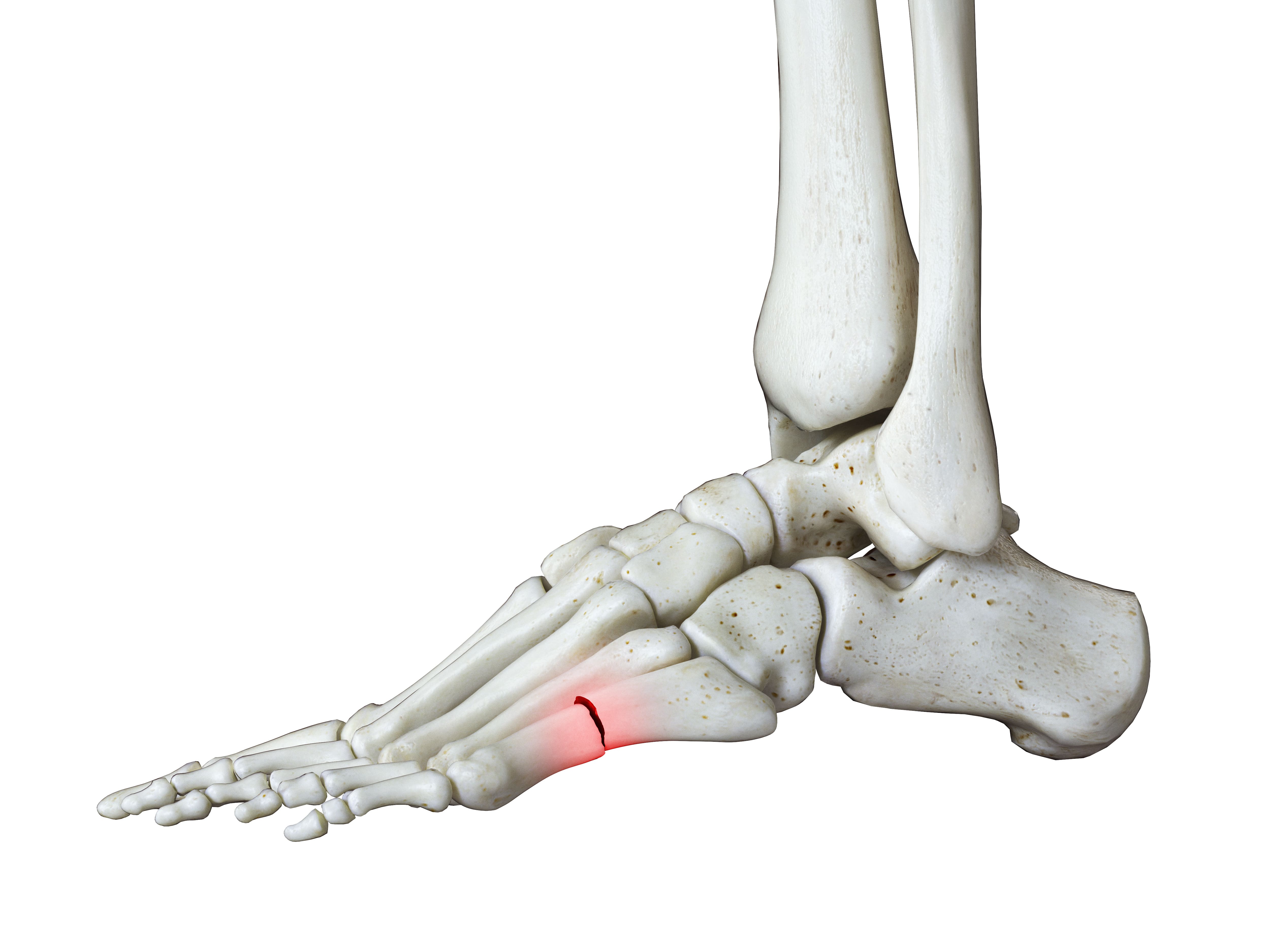 第5中足骨の怪我